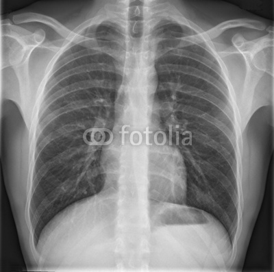 radiograph of chest